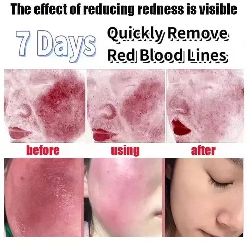 Facial Redness Repair Serum – Sensitive & Dry Skin Serum Facial Serum Qme