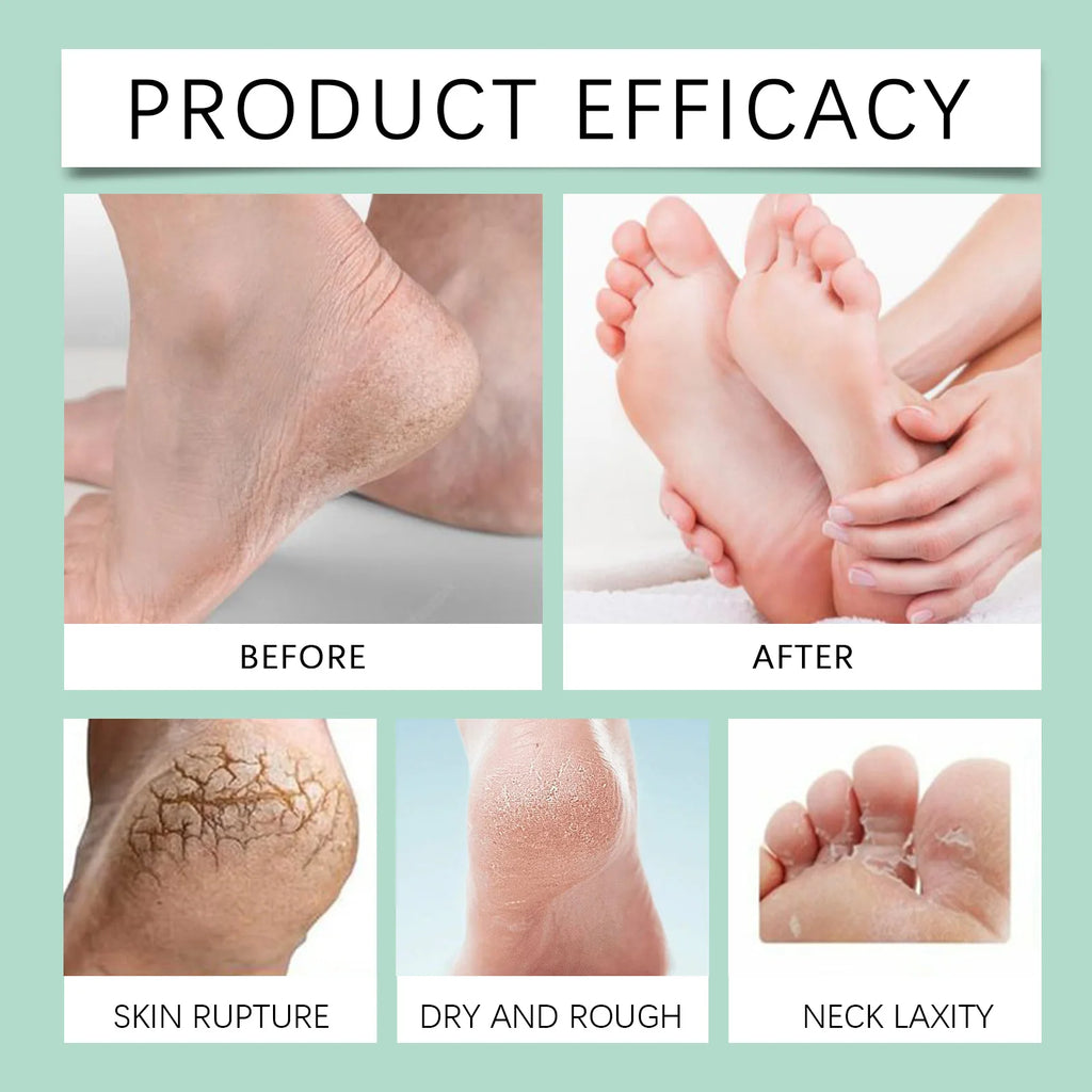 OceAura Foot Exfoliating Spray 100ml – Callus Softener Foot Exfoliating Spray Qst