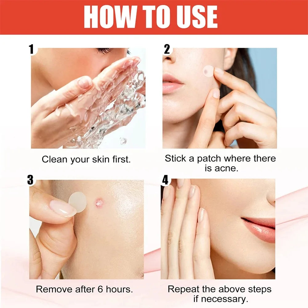 240pcs Heart Hydrocolloid Pimple Patches – Invisible Acne Stickers Acne Pimple Patches Qst