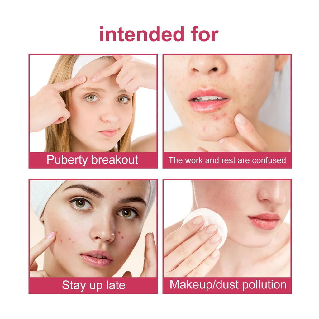 Star Pimple Patches – Colorful Invisible Skin Care Stickers 144pc Pimple Patch Stickers Qme