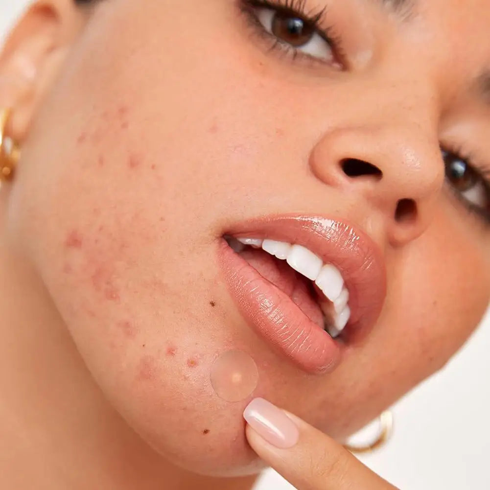 Invisible Hydrocolloid Acne Patches – Blemish Spot Covers Acne Patch Qme