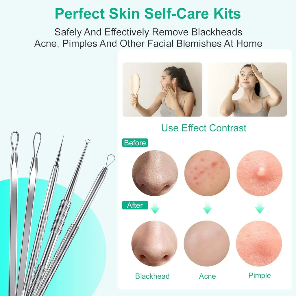 5-Piece Stainless Steel Blackhead Extractor & Blemish Tool Kit Blackhead Extractor Kit Qst