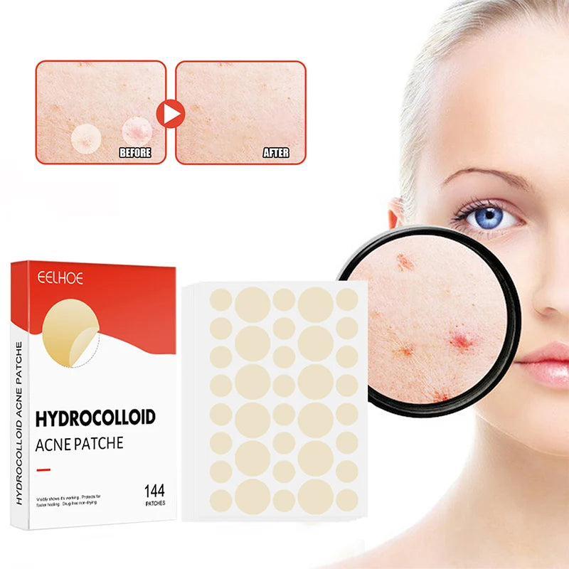 144pcs Hydrocolloid Acne Pimple Patches – 2 Sizes, Invisible Acne Pimple Patch Qst