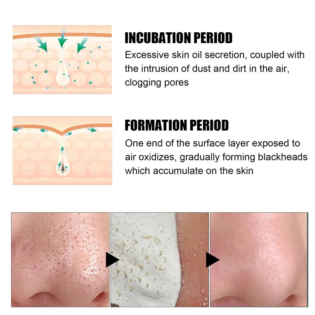 Qme Blackhead Remover Nose Patches – Gentle Deep Clean Nose Cleansing Patches Qme
