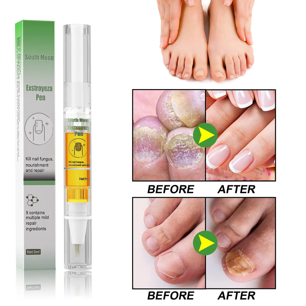 South Moon Nail Repair Pen – Brightening Nail Care Liquid 5ml Nail Care Pen Qst
