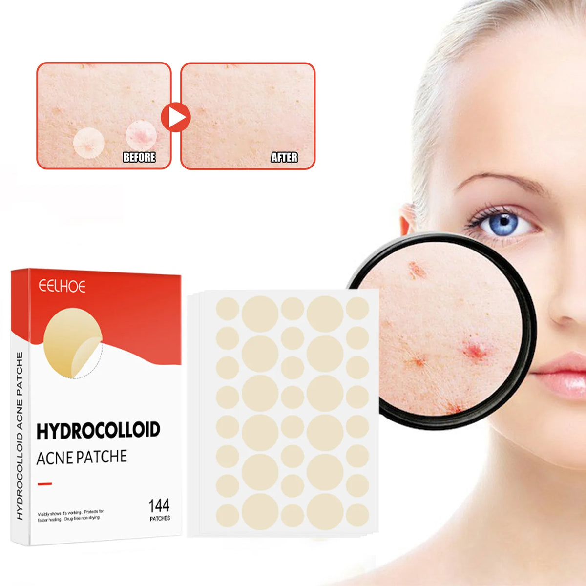144pc Hydrocolloid Acne Pimple Patches – 2 Sizes, Invisible Acne Pimple Patch Qst