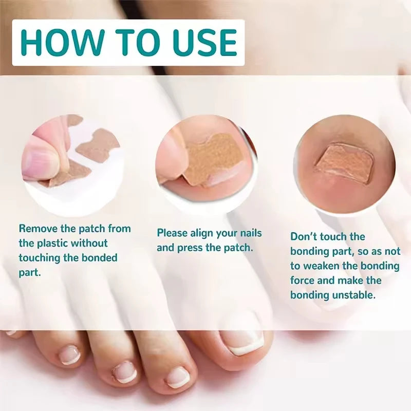 Toenail Correction Strips – Waterproof Pedicure Tool 10/100 Pcs Toenail Correction Strips Qst