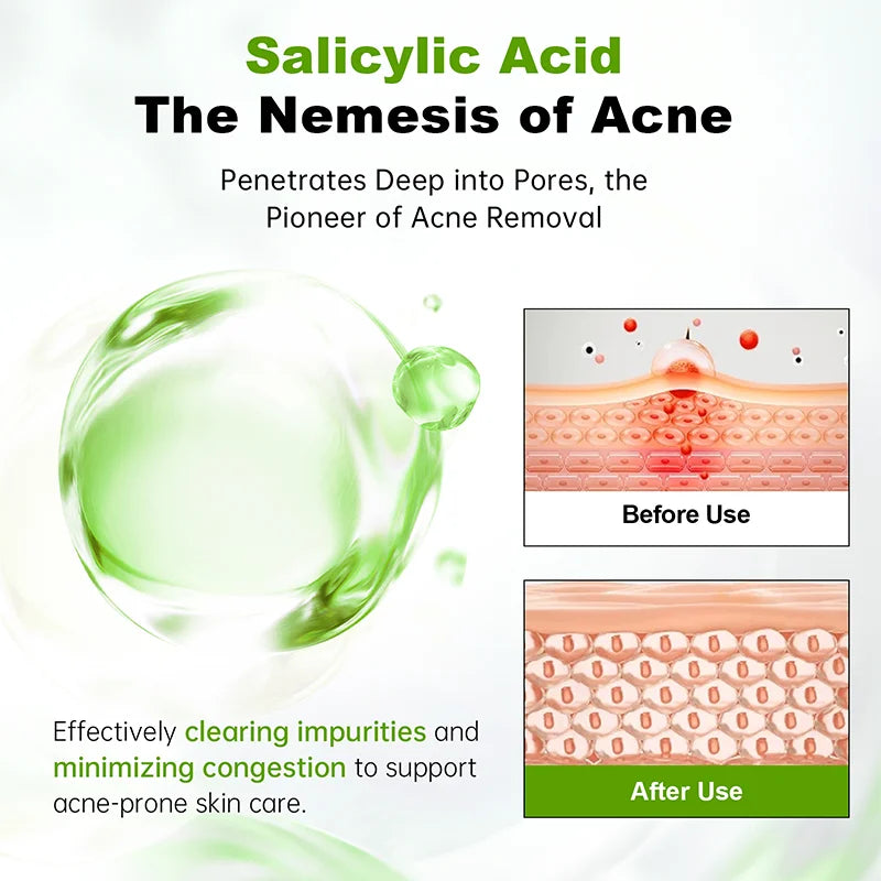 AUQUEST Acne Serum – Salicylic Acid Oil Control Face Serum Acne Face Serum Qst