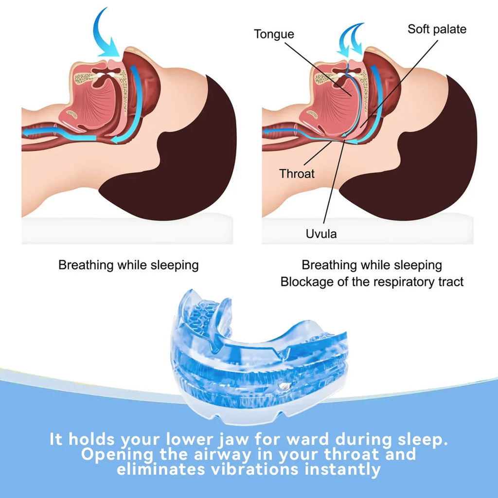 Anti-Snoring Mouth Guard with Adjustment Screws | Night Splint Anti-Snoring Mouth Guard Qst