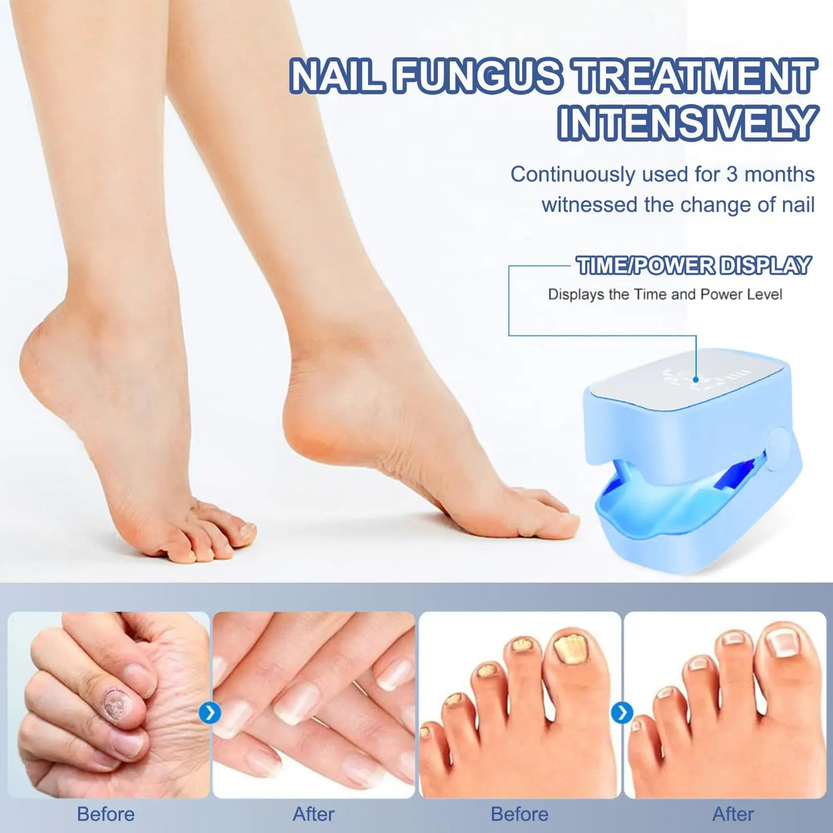 Wireless Laser Nail Care Device – 910nm & 470nm Blue Light Nail Care Device Qst