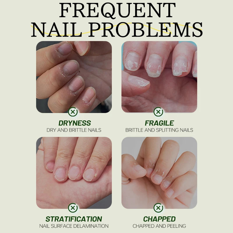 Nail Nutrient Serum – Ginger Extract Nail Repair Liquid 30ml Nail Treatment Serum Qst