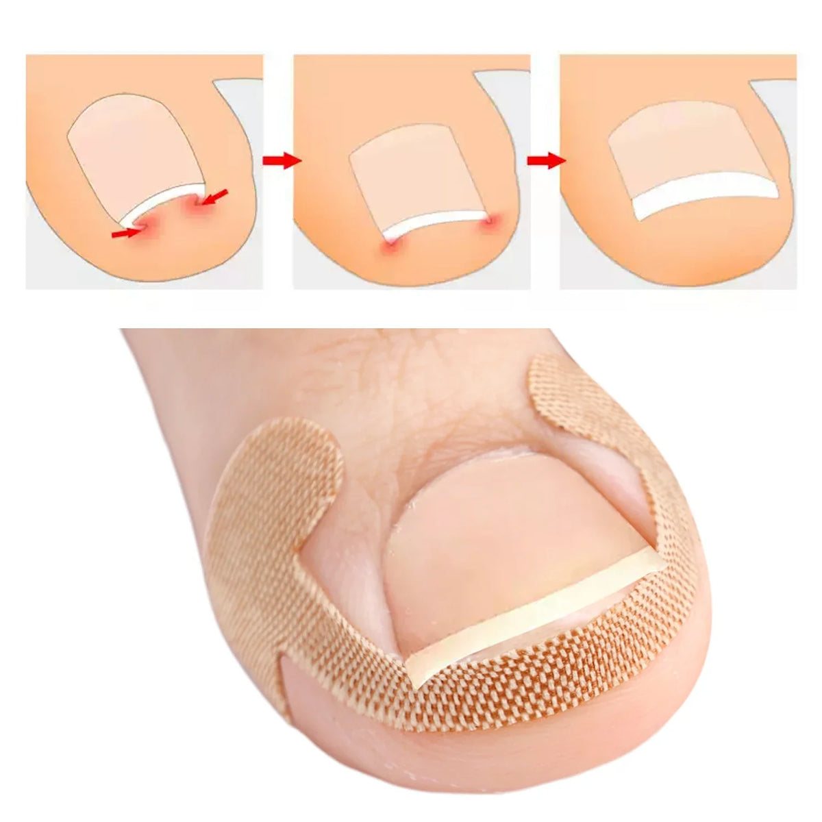 Waterproof Toenail Correction Strips | Lasting Adhesion Nail Correction Strips Qme