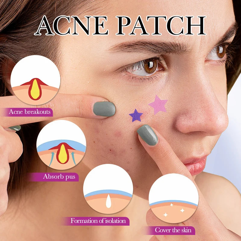 Star Style Acne Patches – 32pc Concealer Stickers with Mirror Acne Patch Qst