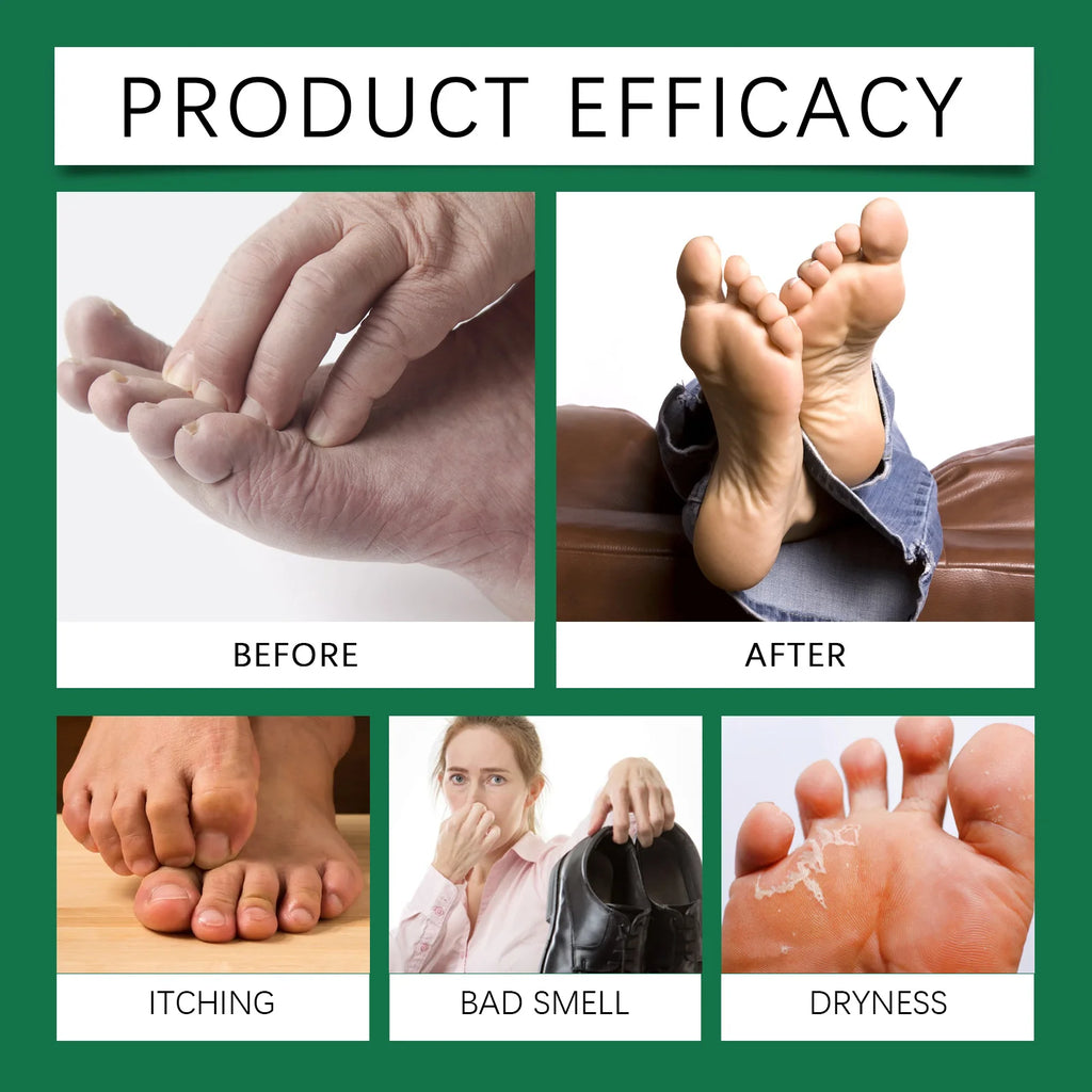 Foot Exfoliating Spray 110ml – Salicylic Acid Callus Softener Foot Exfoliating Spray Qst