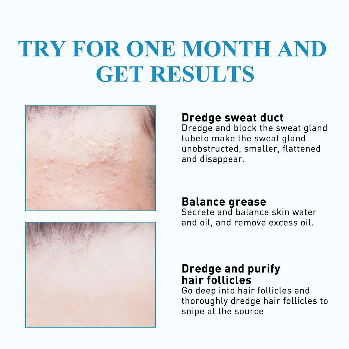 South Moon 144pcs Hydrocolloid Blemish Patches | Salicylic Acid Blemish Patch Qst