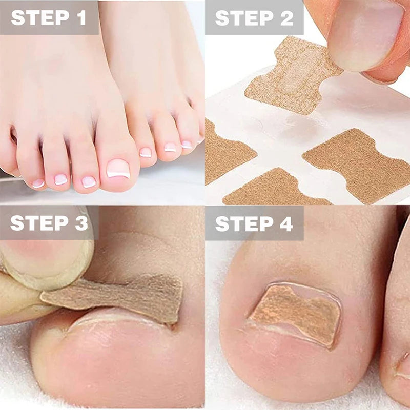 Toenail Correction Strips – Waterproof Pedicure Tool 10/100 Pcs Toenail Correction Strips Qst