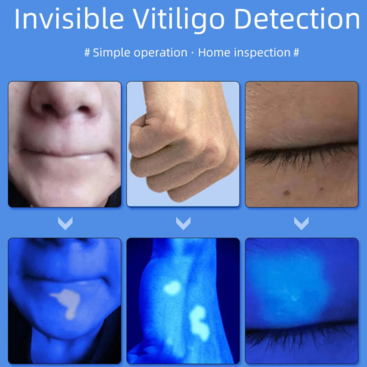 Wood's Lamp UVA Skin Analyzer – 365nm Magnifier | vilnason UV Skin Analyzer Qst