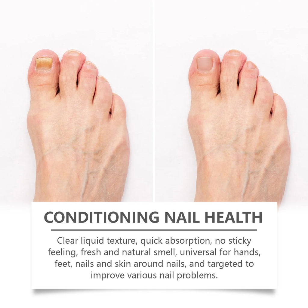 Nail Renewal Serum – Restores Discolored & Damaged Nails 30ml Nail Care Serum Qst