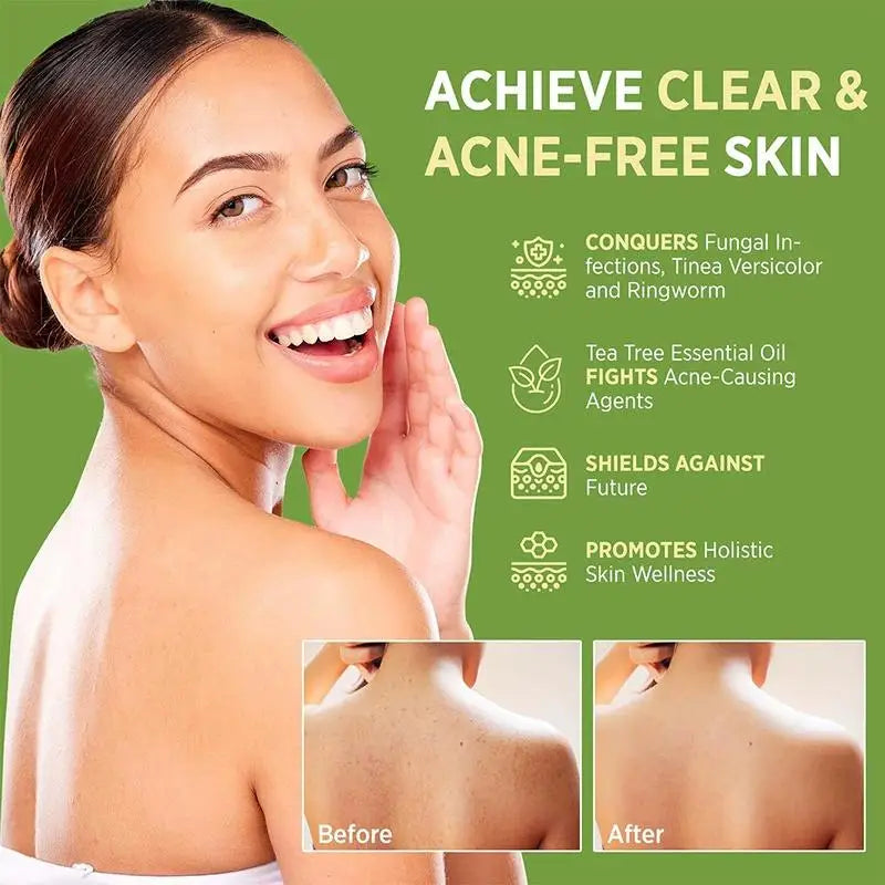 Tea Tree Oil Soap for Sensitive Skin | MIAOFUTONG Bar Cleansing Bar Soap Qme