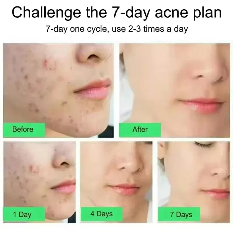 Salicylic Acid Face Cream – Oil Control & Pore-Clearing Moisturizer Salicylic Acid Face Cream Qme