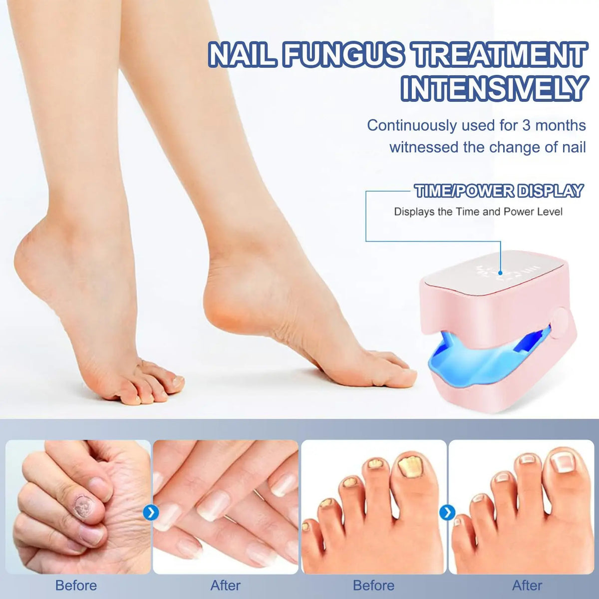 Jitesy Nail Light Therapy Device – Blue LED & Laser Foot Care Nail Light Therapy Device Qst
